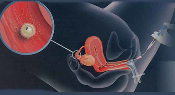 Intrauterine Insemination (IUI) - maa fartility